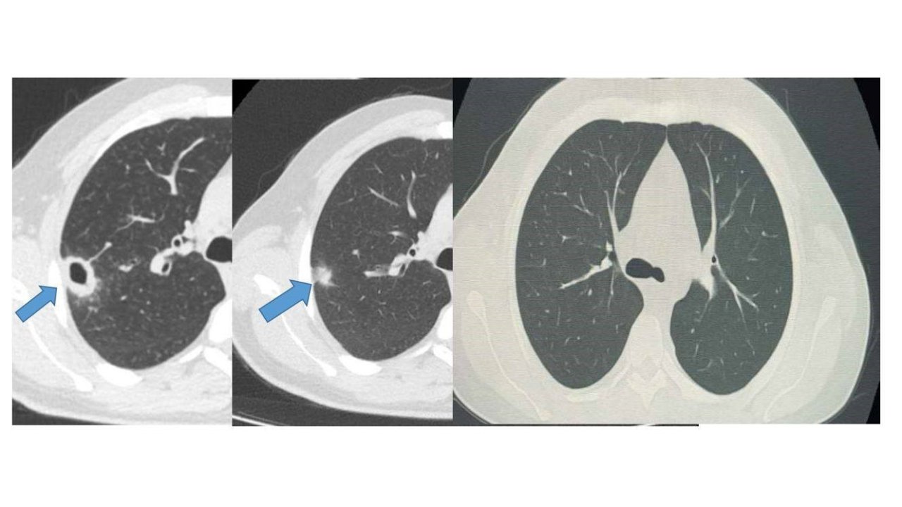 Bayburt’ta 50 yaşındaki hasta erken tanıyla sağlığına kavuştu
