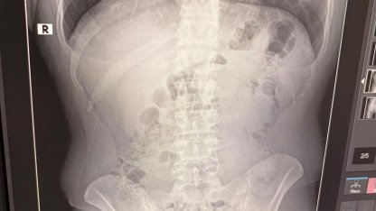 Uşak’ta midelerinden uyuşturucu çıktı: İranlı 3 kişi tutuklandı